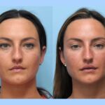 Thread Lift Treatment in Dubai for Gentle Facial Enhancement