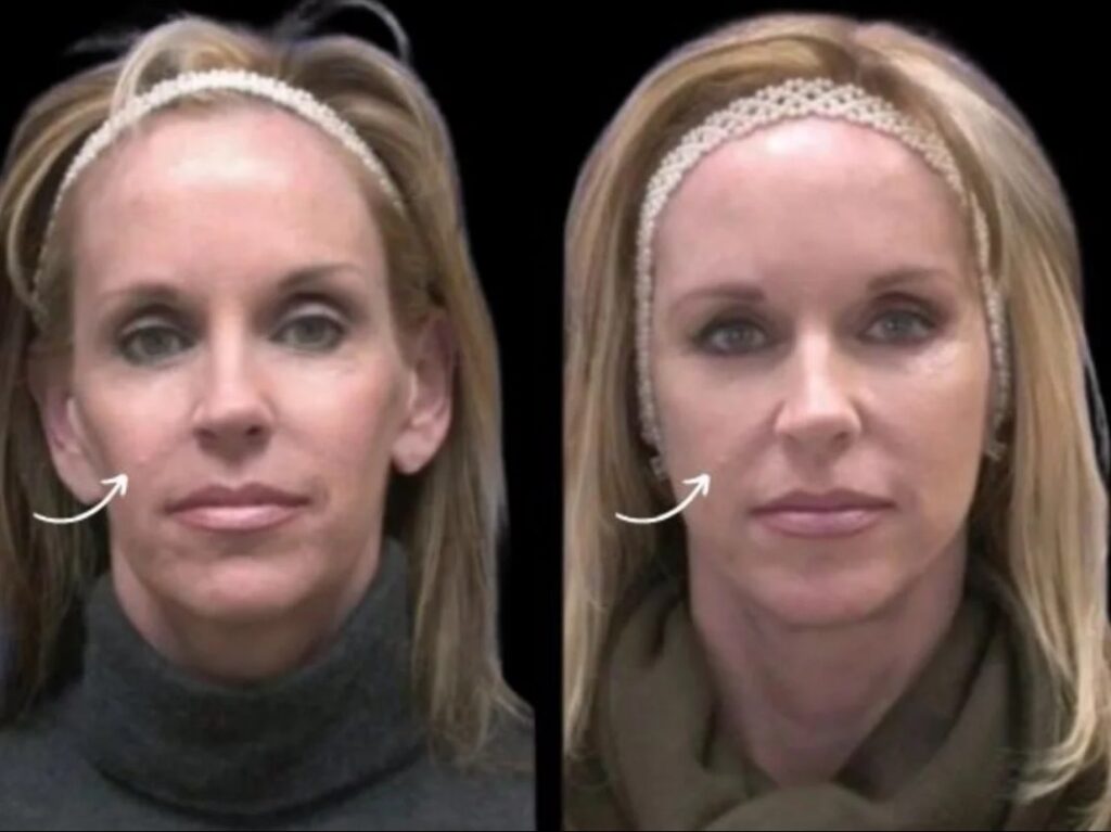 sculptra in dubai