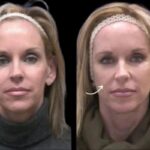 sculptra in dubai