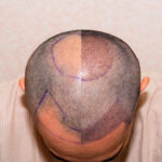 تكلفة زراعة الشعر في دبي