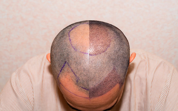 تكلفة زراعة الشعر في دبي