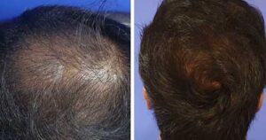 زراعة الشعر في دبي