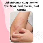 Lichen Planus Supplements That Work