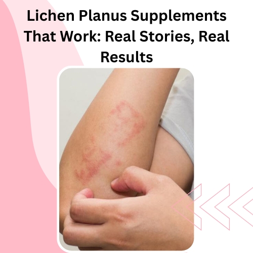Lichen Planus Supplements That Work