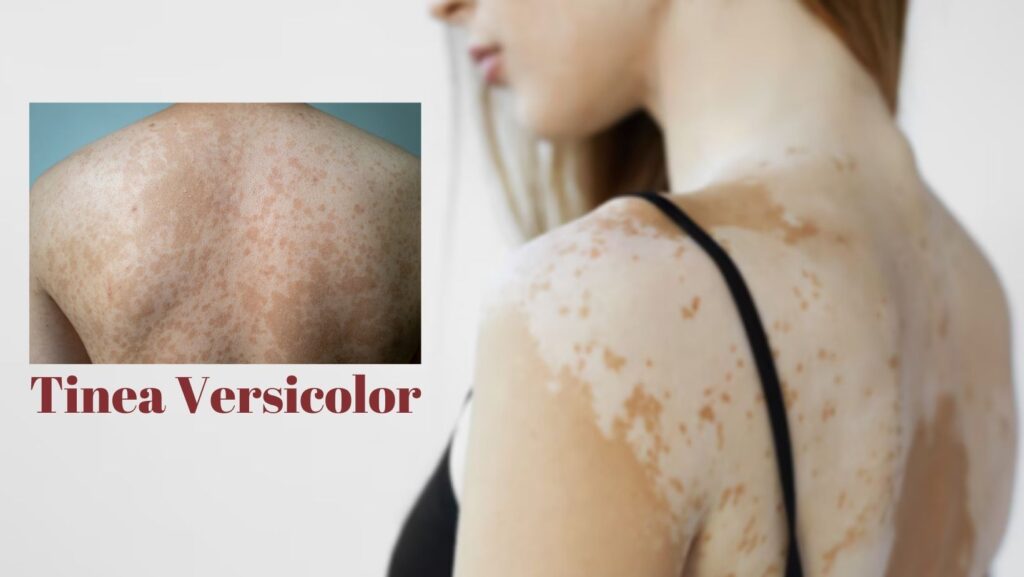 Permanent Tinea Versicolor Treatment Guide