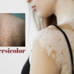 Permanent Tinea Versicolor Treatment Guide