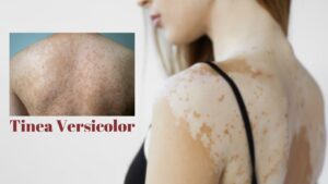 Permanent Tinea Versicolor Treatment Guide