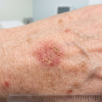 What is Actinic Keratosis?