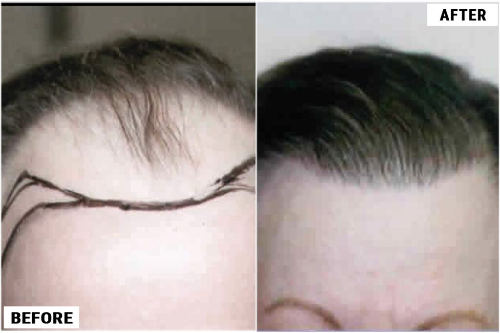 زراعة الشعر في دبي