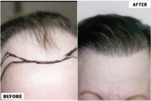 زراعة الشعر في دبي
