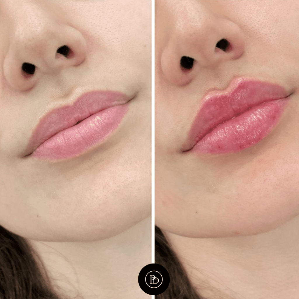 Juvederm in Dubai