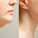 double chin liposuction