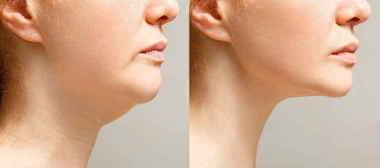 double chin liposuction