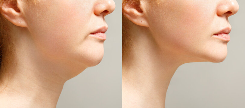 double chin liposuction