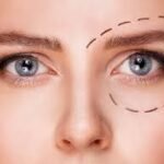 Chirurgie des paupières supérieures à Paris