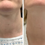 Radiofrequency (RF) Microneedling Treatment in Dubai for Improved Skin Tone