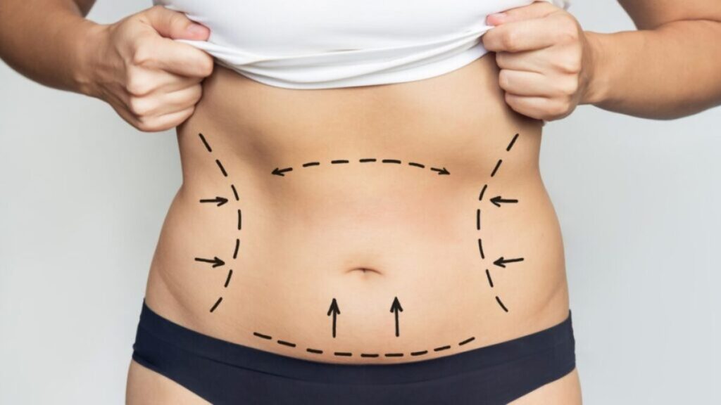 Liposuction in Dubai,