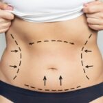 Liposuction in Dubai,