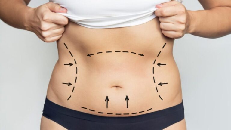 Liposuction in Dubai,
