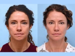 Professional Thread Lift Treatment in Dubai Delivering Natural Anti-Aging Results