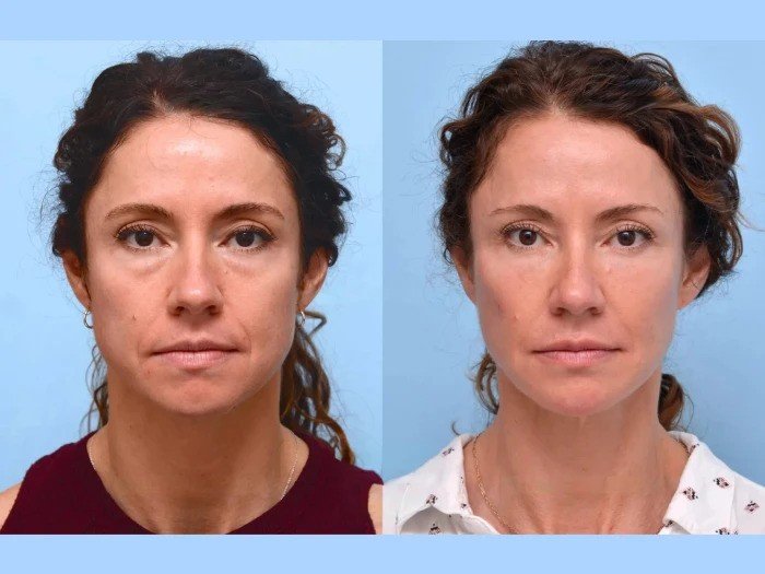 Professional Thread Lift Treatment in Dubai Delivering Natural Anti-Aging Results