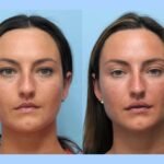 Best Doctors in Dubai Perform Thread Lift Procedures for Natural Skin Rejuvenation