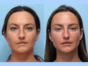 Best Doctors in Dubai Perform Thread Lift Procedures for Natural Skin Rejuvenation