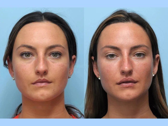 Best Doctors in Dubai Perform Thread Lift Procedures for Natural Skin Rejuvenation