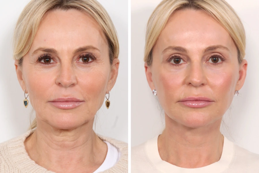 Best Plastic Surgeons in Dubai: Advanced Thread Lift Solutions for Facial Tightening