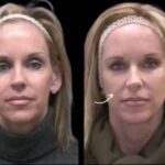 sculptra in dubai