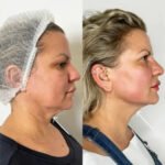 Best Doctors in dubai Transforming Facial Appearance Through Endolift Treatments
