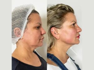 Best Doctors in dubai Transforming Facial Appearance Through Endolift Treatments