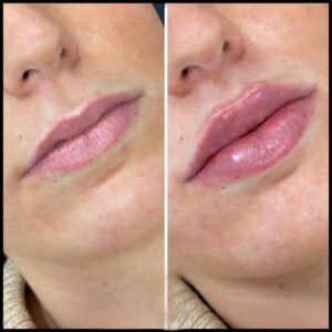 Dermal fillers