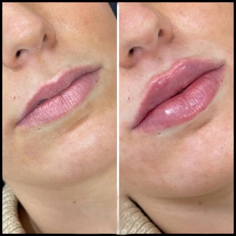 Dermal fillers