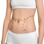 Is-Tummy-Tuck-Surgery-for-You-in-Dubai