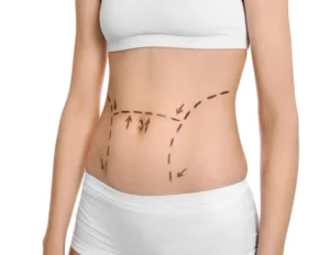 Is-Tummy-Tuck-Surgery-for-You-in-Dubai