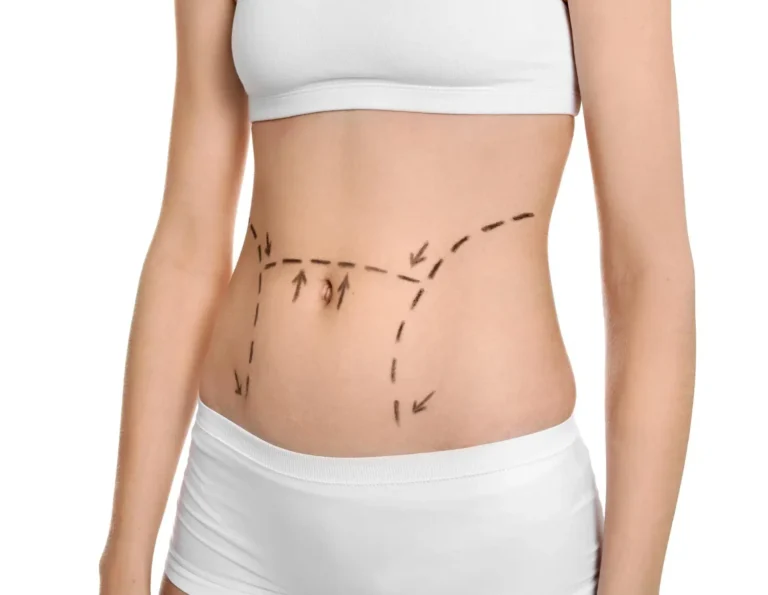 Is-Tummy-Tuck-Surgery-for-You-in-Dubai
