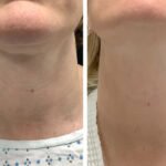 Radiofrequency (RF) Microneedling treatment in Dubai for Advanced Laser Therapy
