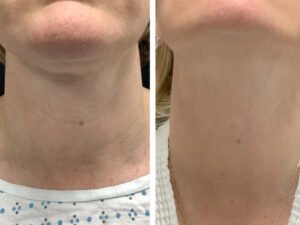 Radiofrequency (RF) Microneedling treatment in Dubai for Advanced Laser Therapy