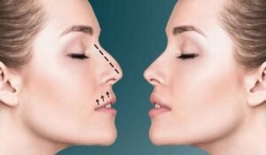 تجميل الأنف في دبي