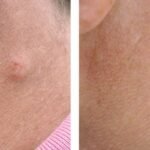 pilar cyst removal