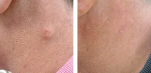 pilar cyst removal