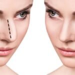 تجميل الأنف في الرياض
