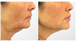 Effective Thread lift in Dubai for Firmer Facial Skin