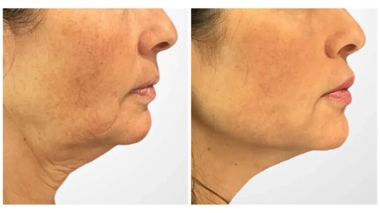 Effective Thread lift in Dubai for Firmer Facial Skin