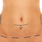 Abdominoplastie à Paris