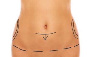 Abdominoplastie à Paris