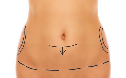Abdominoplastie à Paris