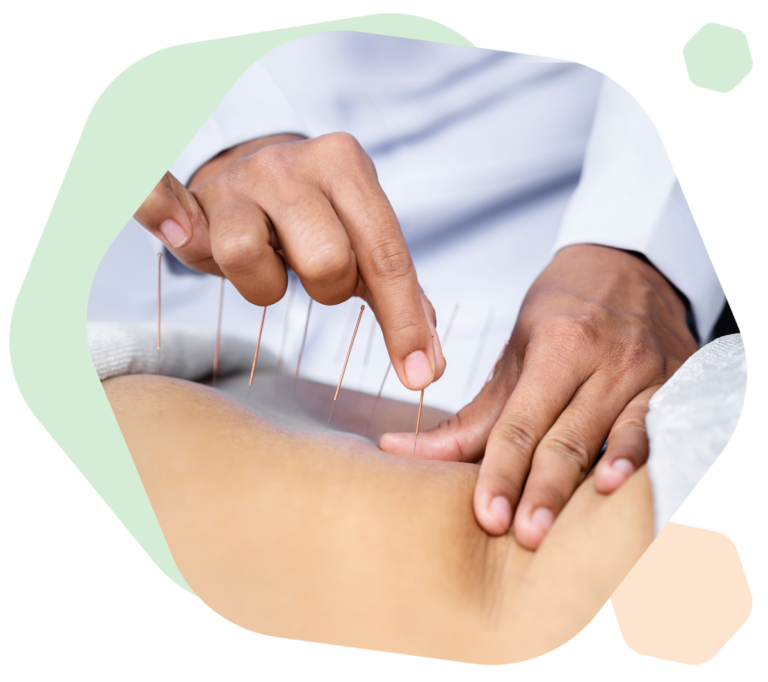 acupuncture in Calgary