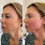 Best Aesthetic Clinics in dubai for Endolift Youthful-Looking Skin
